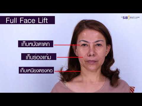 Face Lift ศัลยกรรมดึงหน้า ที่ The Sib Clinic