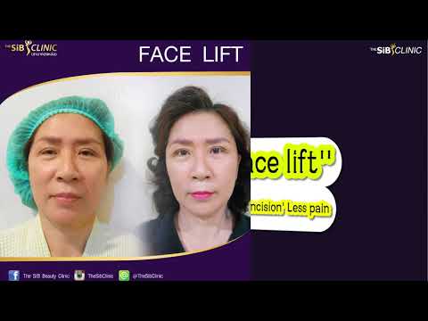 face lift หน้าเรียวยกกระชับทั้งใบหน้า โดย คุณ หมอดารินทร์ ม่วงไทย the sib clini