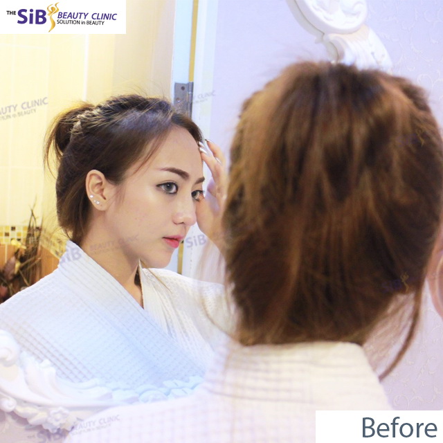 3 8 โหนกให้สุดเท่าที่จะทำได้ กับ หมอดารินทร์ The sib clinic น้อง อากี้ เสริมหน้าผาก รับทรัพย์