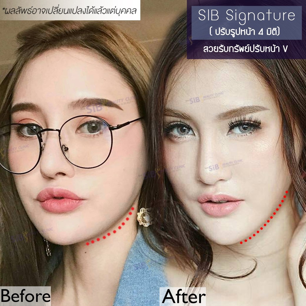 6 4 ร้อยไหมแบบพิเศษหมอดารินทร์ เดอะซิบคลินิก SIB signature มหัศจรรย์ความงามที่สร้างได้แบบป๊อป