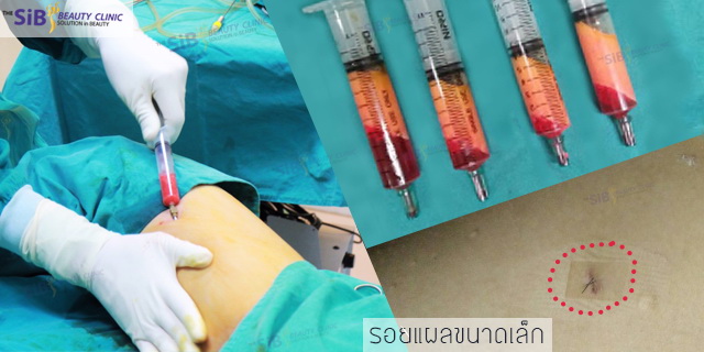 โหนกให้สุดเท่าที่จะทำได้ กับ หมอดารินทร์ The sib clinic น้อง อากี้ เสริมหน้าผาก รับทรัพย์