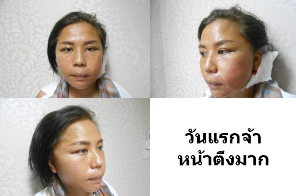 5 1 รีวิวดึงหน้า face lift คุณครู