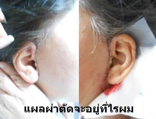 6 1 รีวิวดึงหน้า face lift คุณครู