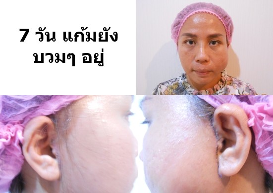 7 1 รีวิวดึงหน้า face lift คุณครู