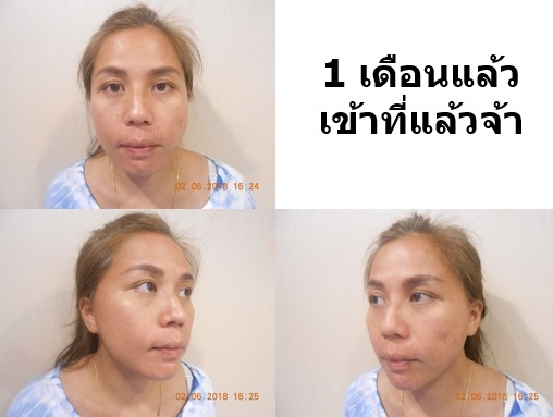 8 1 รีวิวดึงหน้า face lift คุณครู