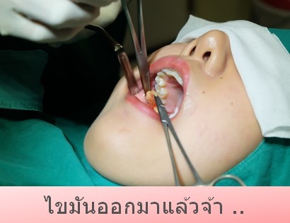 The Sib4 ตัดไขมันกระพุ้งแก้ม หน้าเรียวเว่อร์ ที่ The SiB Clinic ค่ะ