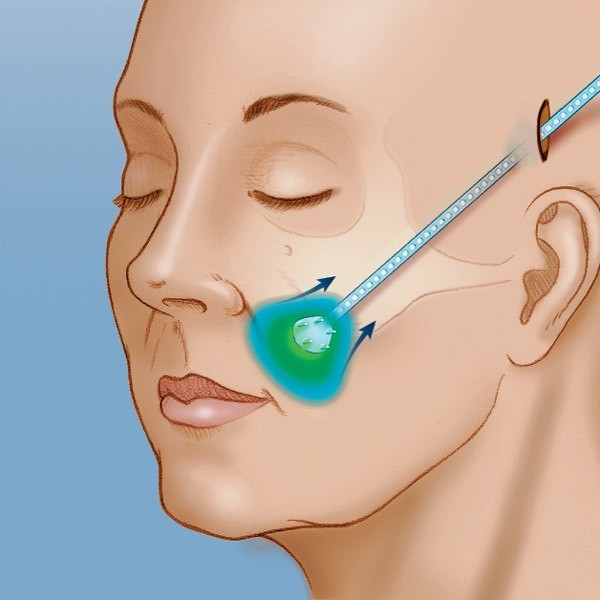 endotine midface ST4 ศัลยกรรมดึงหน้าด้วยเอนโดไทน์