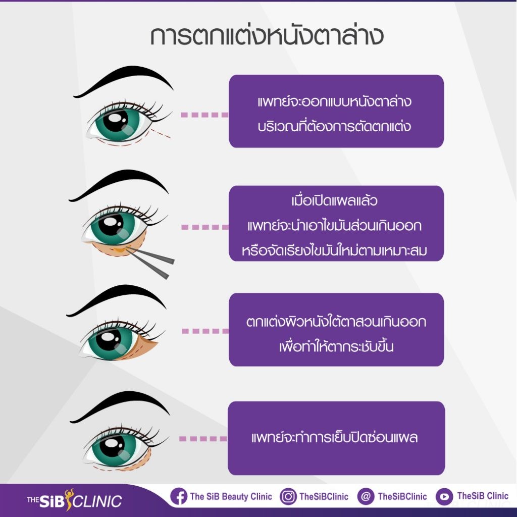 ศัลยกรรมถุงใต้ตา