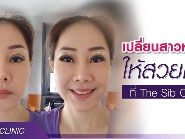 timeline 20180720 221800 รีวิวตาสองชั้น เปลี่ยนสาวหมวย ให้สวยเซี้ย ที่ The Sib Clinic