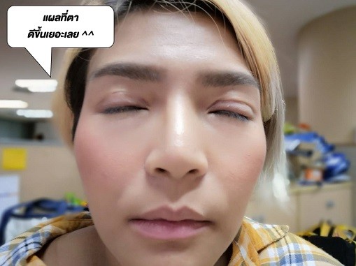 vks89 ทำตาสองชั้น แบบสาย ฝอ เป๊ะปังตามน้องสาว !! #ทำสวยไปด้วยกัน ที่ The SiB Clinic