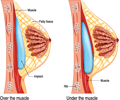 The sib breast placement