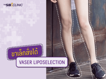 01 ดูดไขมันต้นขา เคสที่ 1 ขาเล็กสั่งได้ VASER LIPOSUCTION