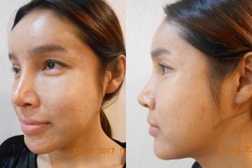 1 8 สวยขึ้นแถมเด็กลงไป 10 ปี ด้วยเทคนิคดี๊ดี Facelift ที่เดอะซิปคลินิก