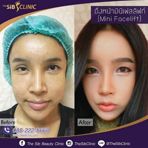 3 6 สวยขึ้นแถมเด็กลงไป 10 ปี ด้วยเทคนิคดี๊ดี Facelift ที่เดอะซิปคลินิก