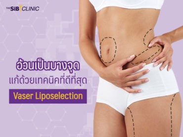 4 1 อ้วนเป็นบางจุด.. แก้ด้วยเทคนิคที่ดีที่สุด ‘Vaser Liposelection’