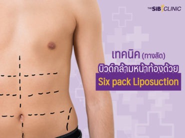 8 เทคนิค(ทางลัด) บิวด์กล้ามหน้าท้องด้วย Six pack Liposuction