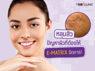 3 ‘หลุมสิว’ ปัญหาผิวที่ต้องให้ E-MATRIX จัดการ!