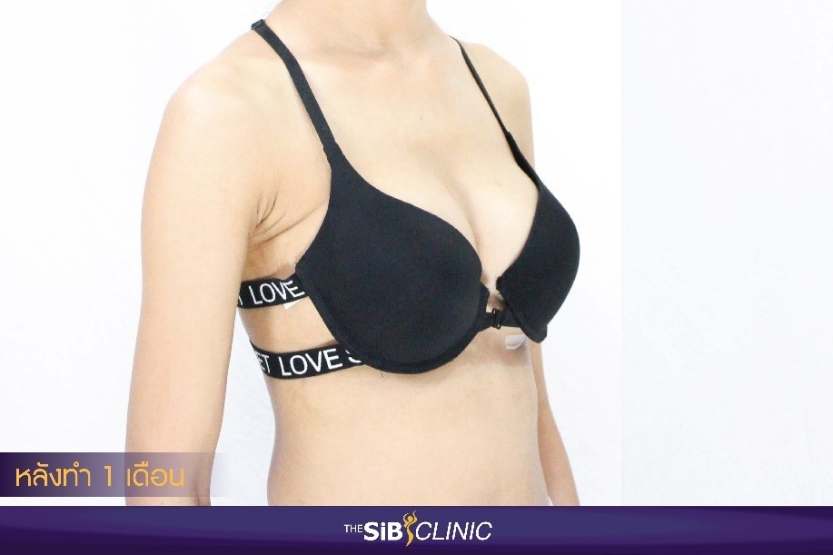 เสริมหน้าอก Thesib clinic 7 รีวิว เสริมหน้าอกวันวาเลนไทน์ อัพหน้าอกใหม่ 300 cc.