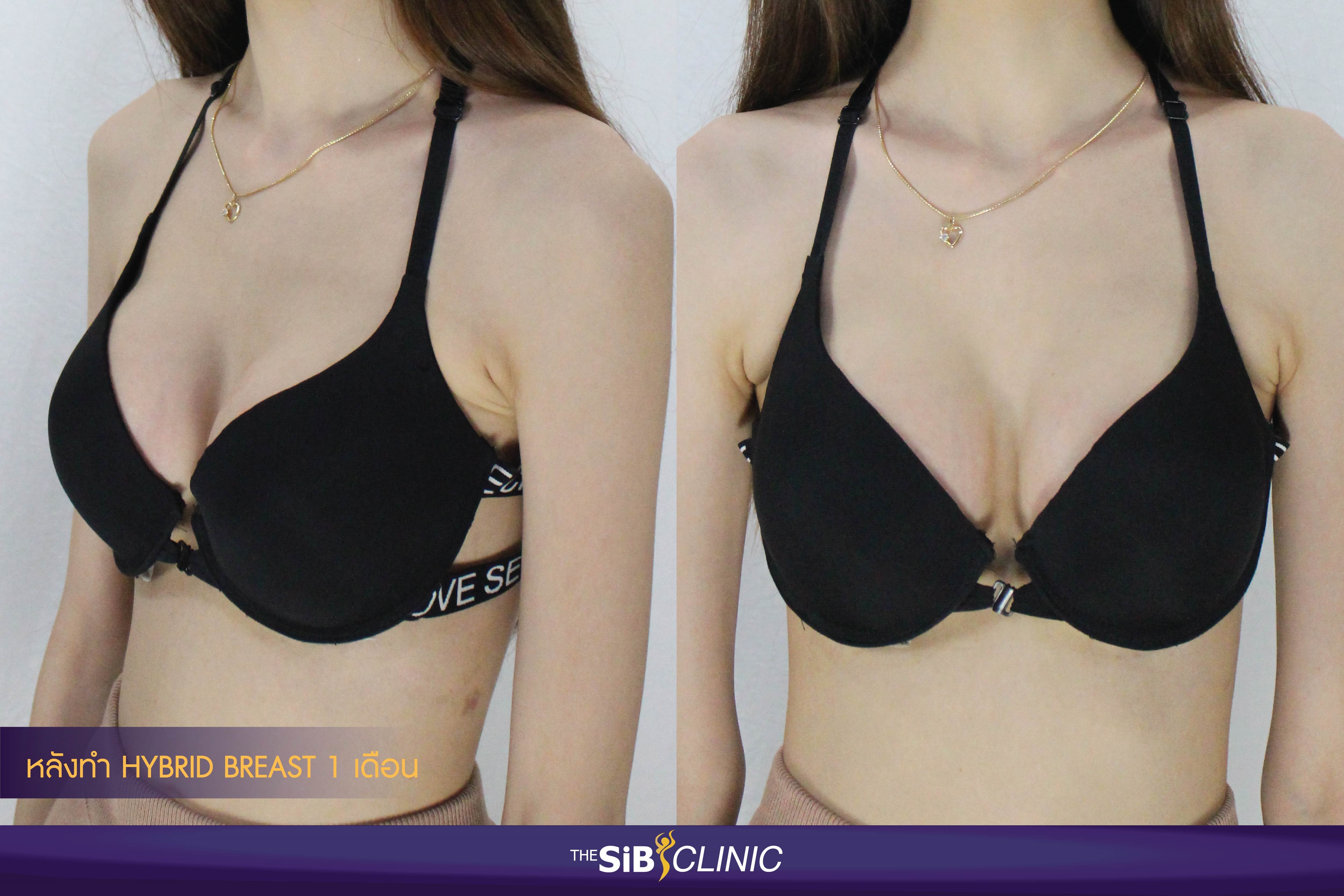 Thesib Clinic คุณพลอย8 รีวิวเสริมหน้าอก HYBRID BREAST คุณพลอย