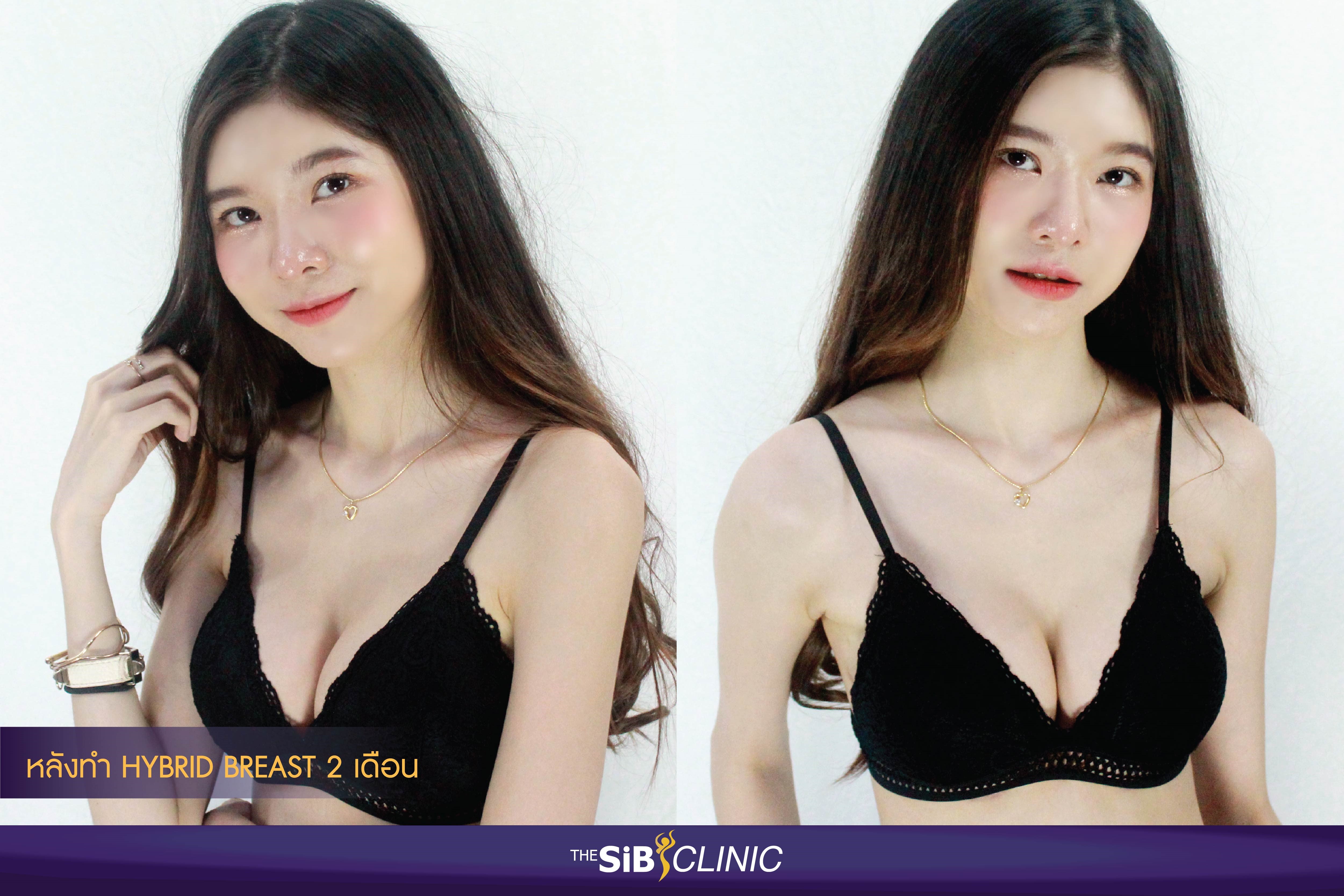 รีวิวเสริมหน้าอก hybrid breast สาวไซส์เล็ก มาอัพไซส์ 350 cc.