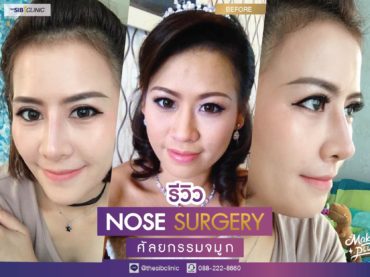 08 รีวิว เสริมจมูก ที่ เดอะซิบส์ คลินิก ชีวิตคือดีย์ แฮปปี้ขึ้นสุด ๆ