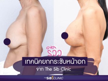 01.1 แก้หน้าอกเจ็บไหม ในวัย 64