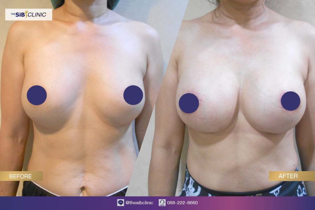 ทำหน้าอก hybrid Breast เดอะซิบ คลินิก 6 ศัลยกรรมเสริมหน้าอก เทคนิค Hybrid Breast ที่ เดอะซิบส์ คลินิก