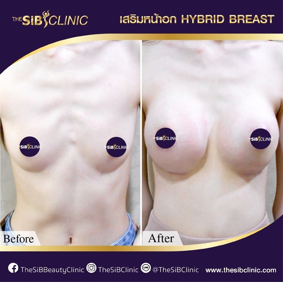 ทำหน้าอก hybrid Breast เดอะซิบ คลินิก 8 ศัลยกรรมเสริมหน้าอก เทคนิค Hybrid Breast ที่ เดอะซิบส์ คลินิก