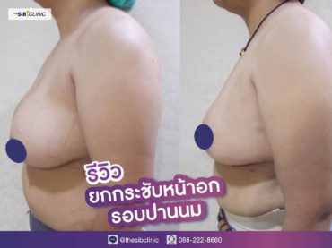 ทำหน้าอก ทำนม เดอะซิบส์ คลินิก คุณจิ1 รีวิวแก้หน้าอก แชร์บทเรียนราคาแพง