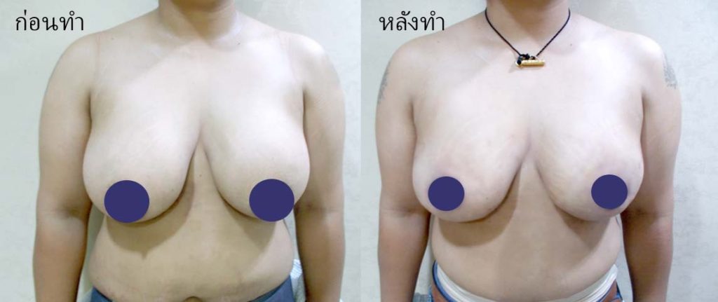 ทำหน้าอก ทำนม เดอะซิบส์ คลินิก คุณจิ10 รีวิวแก้หน้าอก แชร์บทเรียนราคาแพง