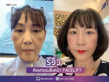 ยกกระชับหน้า เดอะซิบส์ คลินิก คุณสว่างจิต 1 รีวิว Facelift พลิกชีวิต ที่ เดอะซิบส์ คลินิก ย้อนวัยสาวที่ไทย ไม่ต้องไปไกลถึงเกาหลี