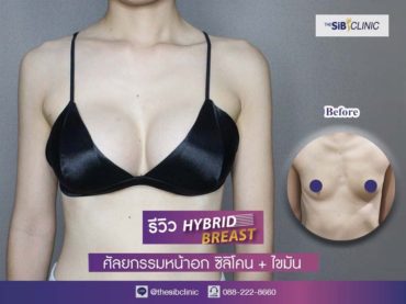 ทำหน้าอก เดอะซิบส์ คลินิก คุณบี13 รีวิว ปัญหาไม่มีเนื้อนม ทำนมแล้วกลัวเป็นบล็อก Hybrid breast ที่ เดอะซิบส์ คลินิก สิช่วยได้