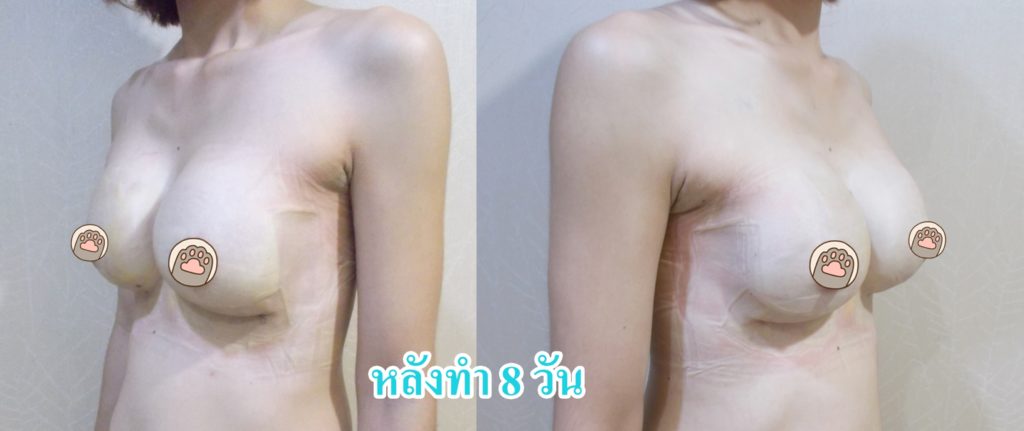 ทำหน้าอก เดอะซิบส์ คลินิก คุณบี4 รีวิว ปัญหาไม่มีเนื้อนม ทำนมแล้วกลัวเป็นบล็อก Hybrid breast ที่ เดอะซิบส์ คลินิก สิช่วยได้