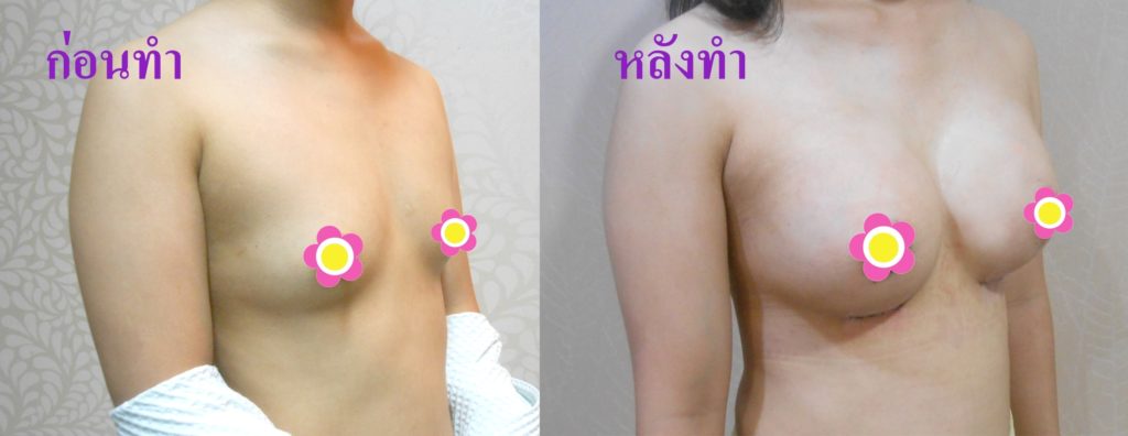 ทำหน้าอก เดอะซิบส์ คลินิก คุณเอม10 รีวิว แชร์ประสบการณ์ เสริมหน้าอก ทรง Barbie Breast ที่ เดอะซิบส์ คลินิก