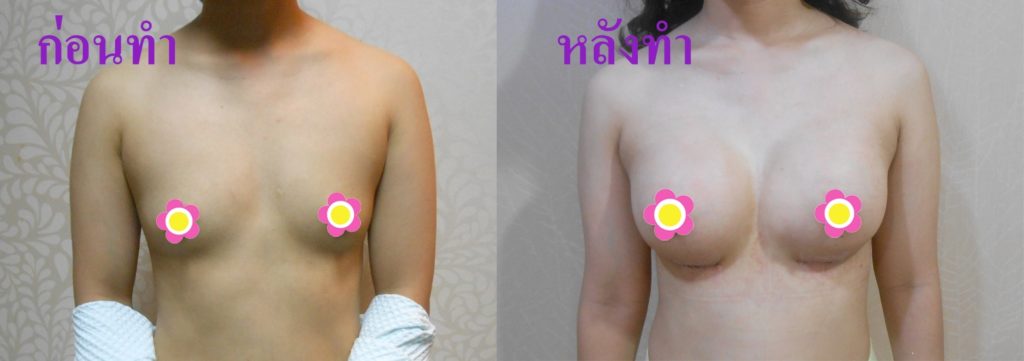 ทำหน้าอก เดอะซิบส์ คลินิก คุณเอม11 รีวิว แชร์ประสบการณ์ เสริมหน้าอก ทรง Barbie Breast ที่ เดอะซิบส์ คลินิก