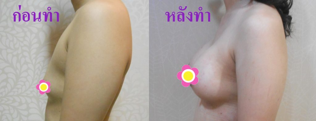 ทำหน้าอก เดอะซิบส์ คลินิก คุณเอม12 รีวิว แชร์ประสบการณ์ เสริมหน้าอก ทรง Barbie Breast ที่ เดอะซิบส์ คลินิก