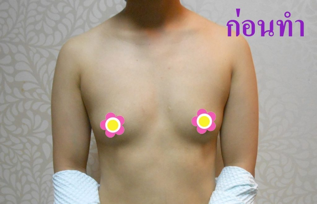 ทำหน้าอก เดอะซิบส์ คลินิก คุณเอม2 รีวิว แชร์ประสบการณ์ เสริมหน้าอก ทรง Barbie Breast ที่ เดอะซิบส์ คลินิก