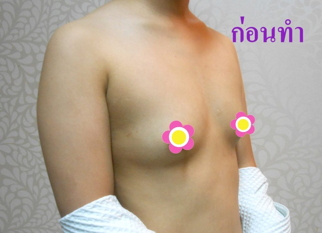 ทำหน้าอก เดอะซิบส์ คลินิก คุณเอม3 รีวิว แชร์ประสบการณ์ เสริมหน้าอก ทรง Barbie Breast ที่ เดอะซิบส์ คลินิก