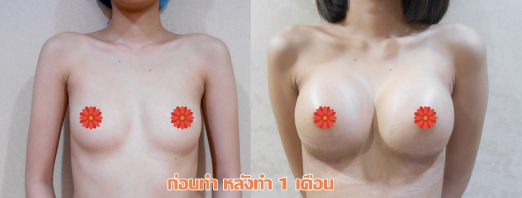 ทำหน้าอก เดอะซิบส์ คลินิก คุณแอม1 รีวิว เสริมหน้าอกทรง Barbie Breast ที่ เดอะซิบส์ คลินิก ค่ะ