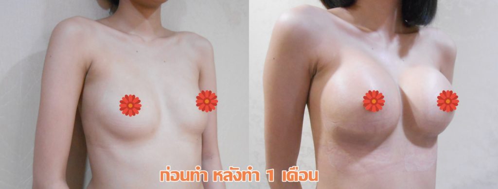 ทำหน้าอก เดอะซิบส์ คลินิก คุณแอม2 รีวิว เสริมหน้าอกทรง Barbie Breast ที่ เดอะซิบส์ คลินิก ค่ะ