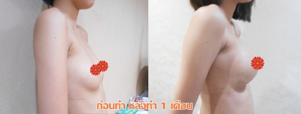 ทำหน้าอก เดอะซิบส์ คลินิก คุณแอม4 รีวิว เสริมหน้าอกทรง Barbie Breast ที่ เดอะซิบส์ คลินิก ค่ะ