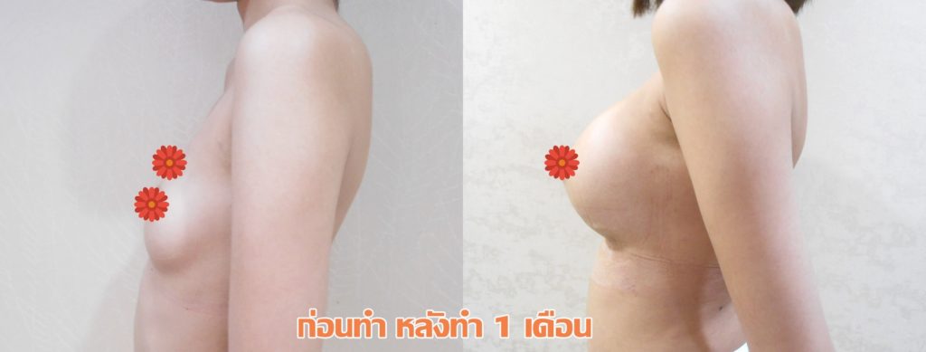 ทำหน้าอก เดอะซิบส์ คลินิก คุณแอม5 รีวิว เสริมหน้าอกทรง Barbie Breast ที่ เดอะซิบส์ คลินิก ค่ะ