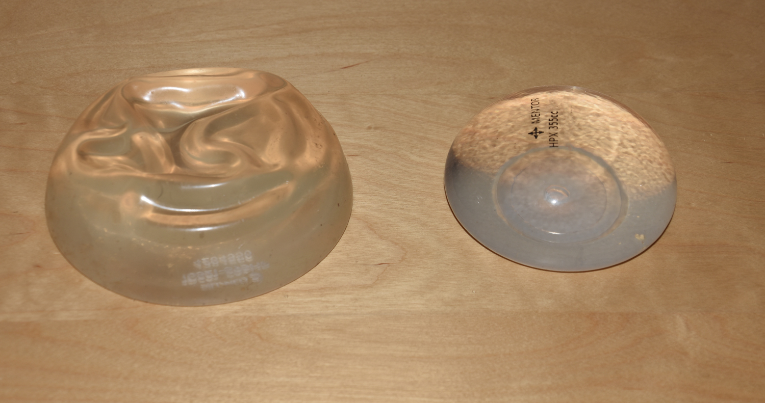 Full Filled vs Standard Filled Breast IMplants Dr Barry Eppley Indianapolis ซิลิโคน Mentor Memory Gel Xtra