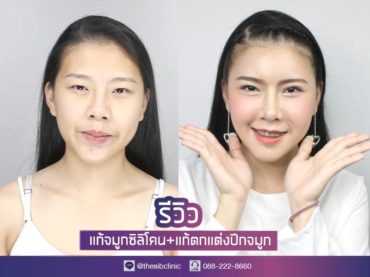 3 Makeover ที่เดอะซิบส์ Ep. 2 แก้จมูก+แก้ตกแต่งปีกจมูกให้เท่ากัน