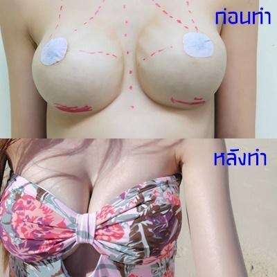 แก้หน้าอกราคาเท่าไหร่1 ปัจจัยมีผลต่อค่าใช้จ่ายสิ่งที่ต้องรู้