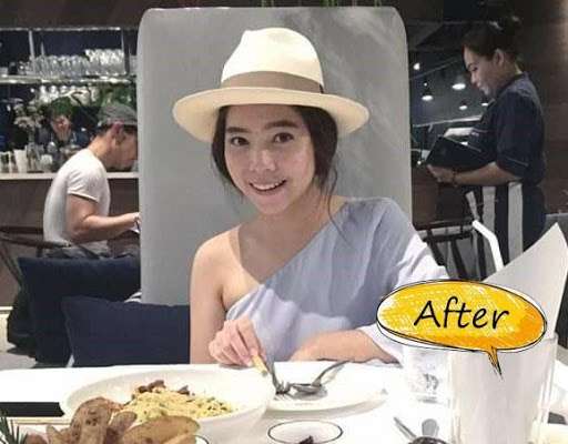 จบปัญหาแก้มป่องโดยไม่ต้องผ่าตัด! แค่ตัดไขมันกระพุ้งแก้ม