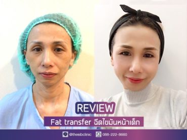 รีวิวเติมไขมัน หน้าเด็กที่ The SiB Clinic