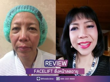 ดึงหน้า หน้าเด็ก เดอะซิบส์ คลินิก 1 รีวิวอัพเดตหน้าใหม่ หลังทำ Facelift ที่ เดอะซิบส์ คลินิก ล่าสุด สาวขึ้นจนทุกคนทัก!