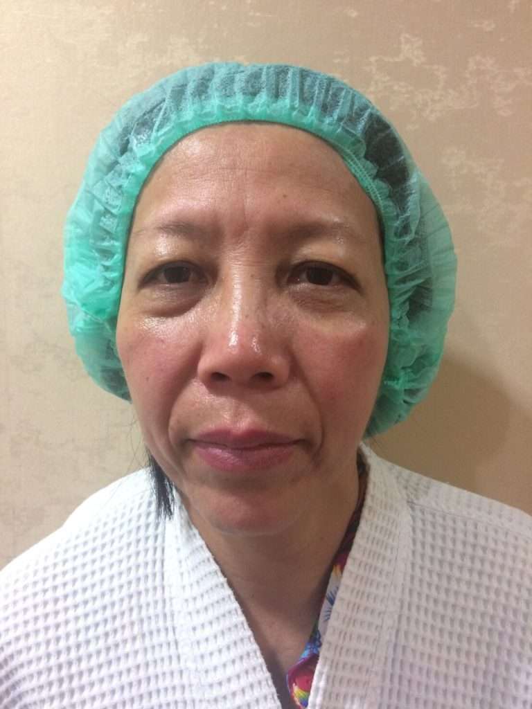 รีวิวดึงหน้า facelift หลังทำ ที่เดอะซิบส์ คลินิก ล่าสุด สาวขึ้นจนทุกคนทัก!