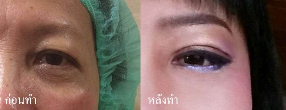 รีวิวดึงหน้า facelift หลังทำ ที่เดอะซิบส์ คลินิก ล่าสุด สาวขึ้นจนทุกคนทัก!